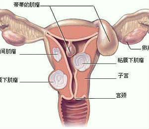 子宫肌瘤治疗