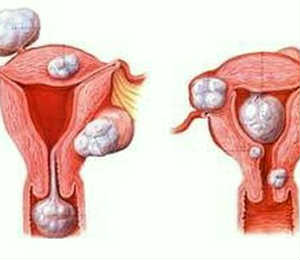 治疗子宫肌瘤医院
