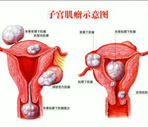 子宫肌瘤症状