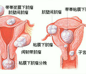 卵巢早衰病因