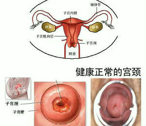 宫颈糜烂治疗