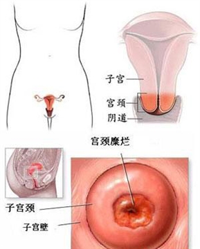 宫颈糜烂可导致的并发症