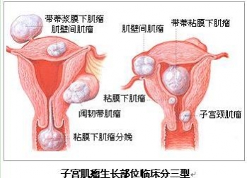 子宫肌瘤有哪些症状呢