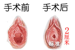 宝鸡哪家医院做阴道紧缩术最好